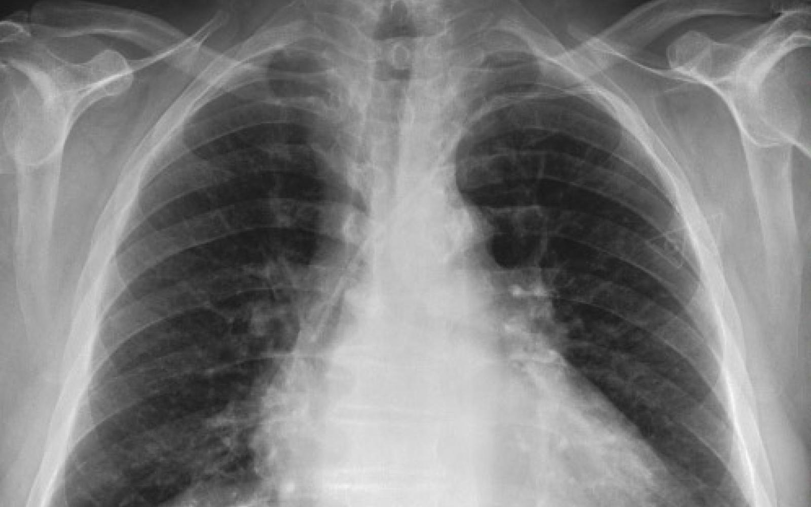 MIMIC Chest X-Ray database to provide researchers access to over ...